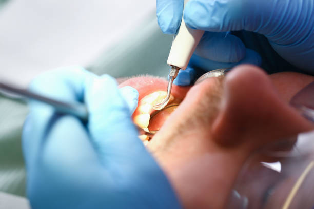 Best Emergency Root Canal Treatment in Midway, KY